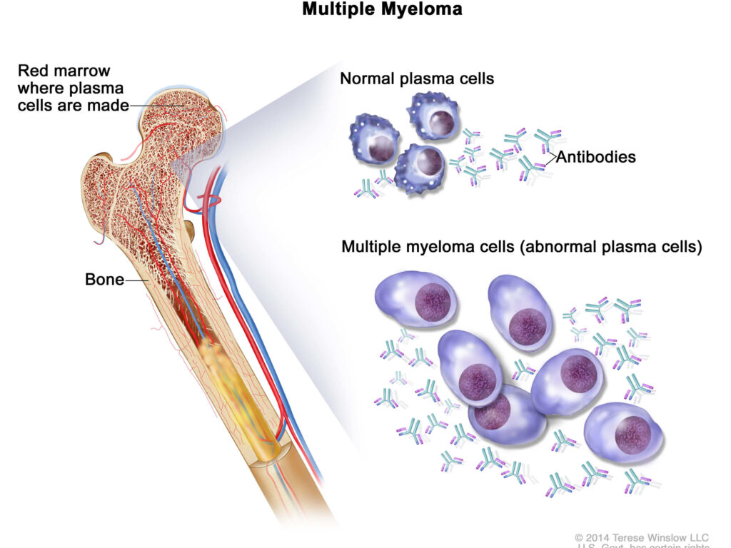 Plasma Cell Neoplasms Including Multiple Myeloma Patient Version NCI